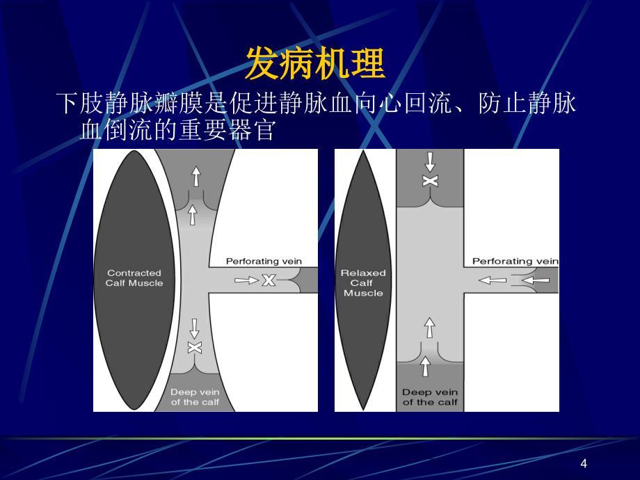 大隐静脉激光治疗PPT优秀课件_第4页