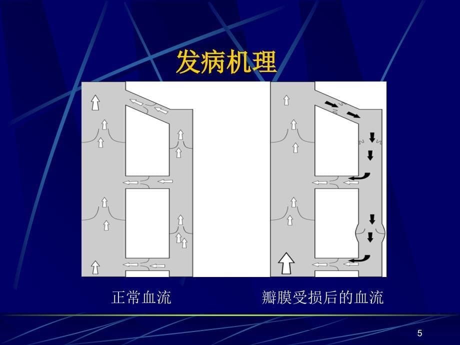 大隐静脉激光治疗PPT优秀课件_第5页