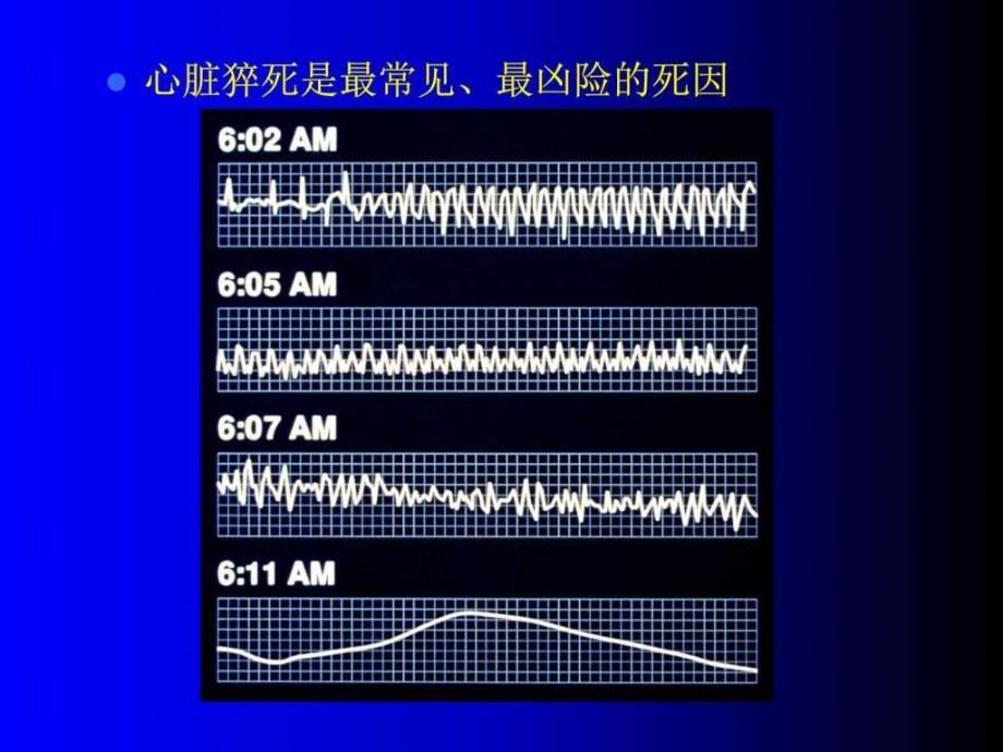 心脏骤停和心脏性猝死图文.ppt_第3页