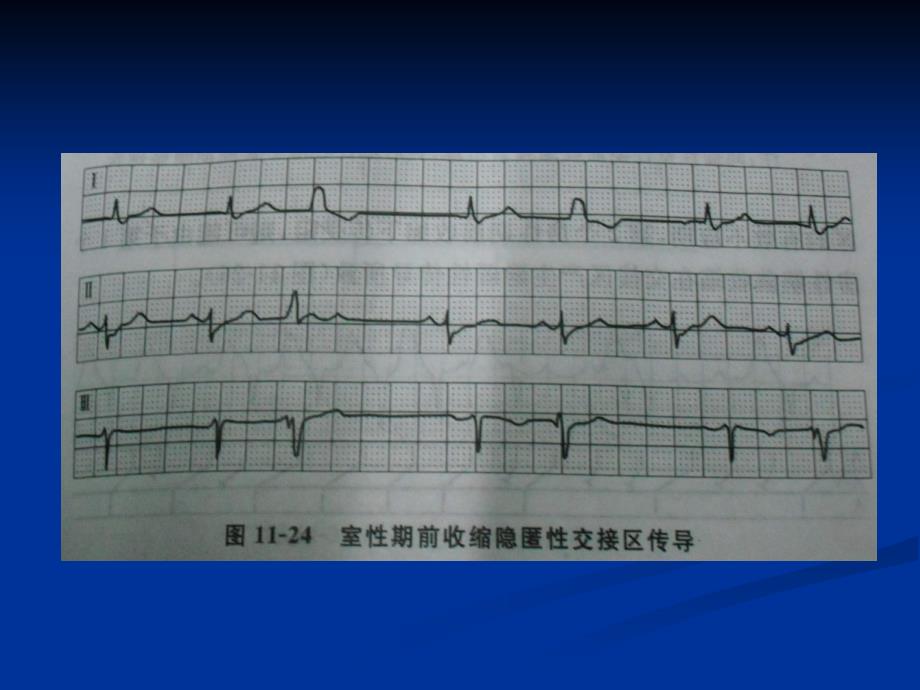 心律失常合并的电生理现象ppt课件精选文档_第3页