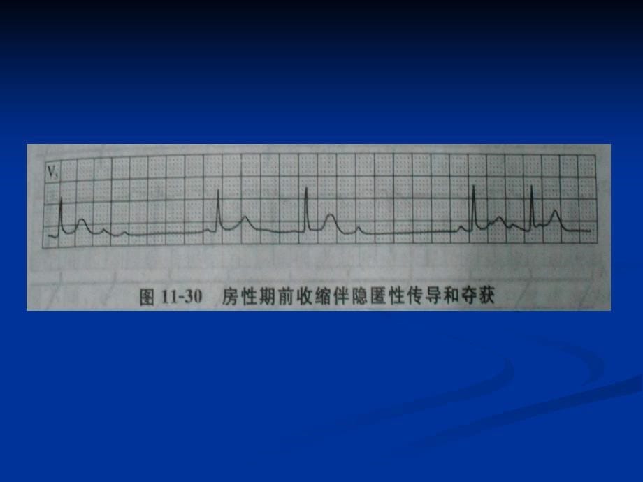 心律失常合并的电生理现象ppt课件精选文档_第5页