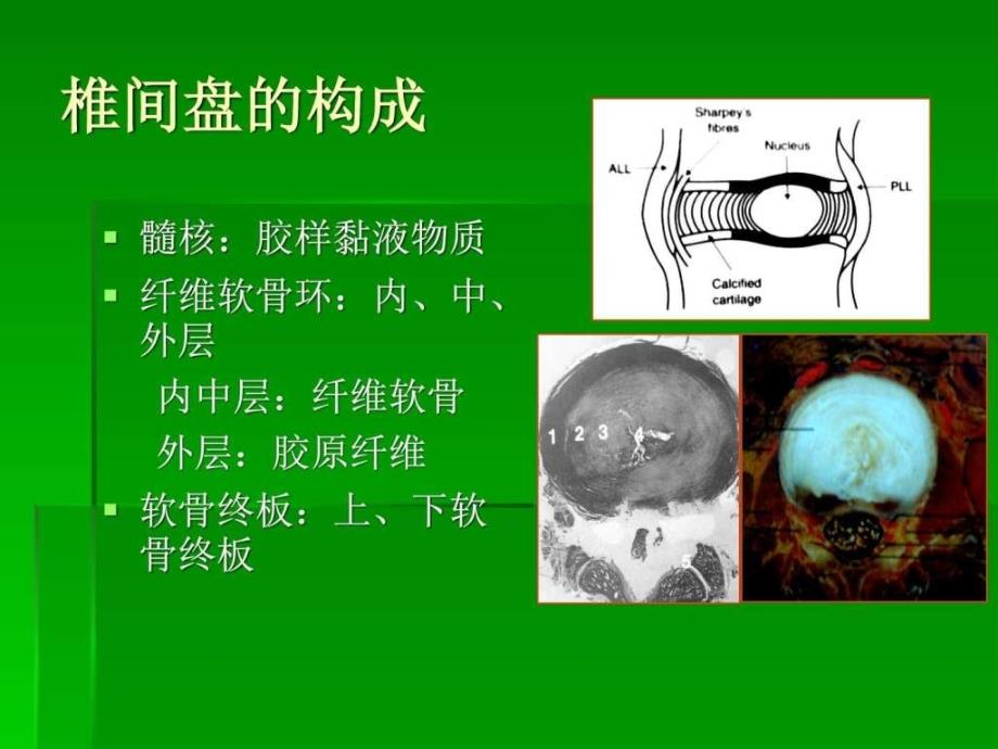 椎间盘突出的影像学诊断ppt课件_第4页