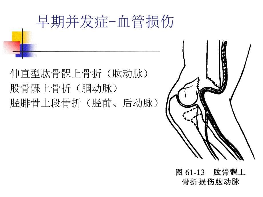 骨折并发症的护理PPT课件_第5页