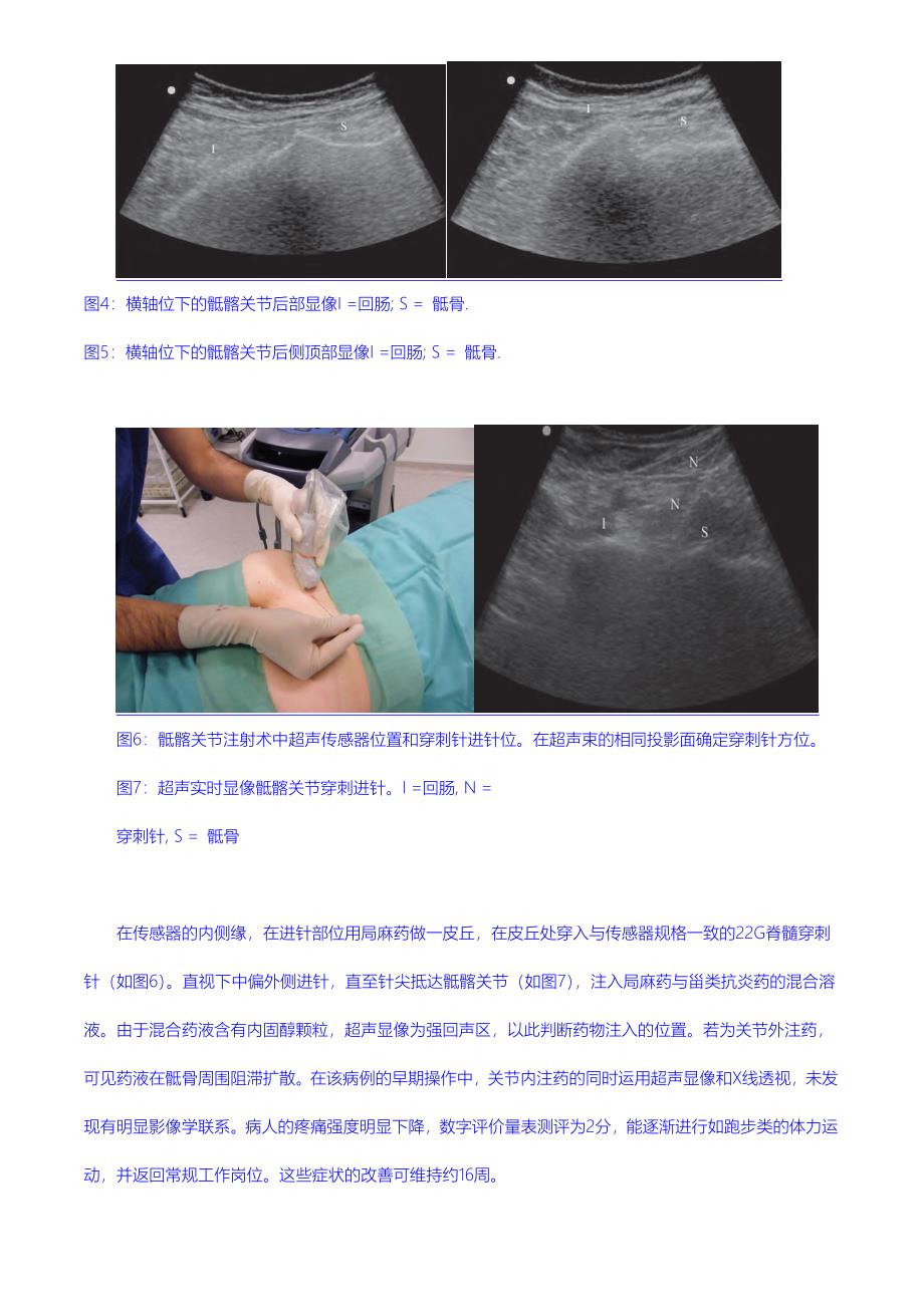 超声引导下的骶髂关节注射术.doc_第3页