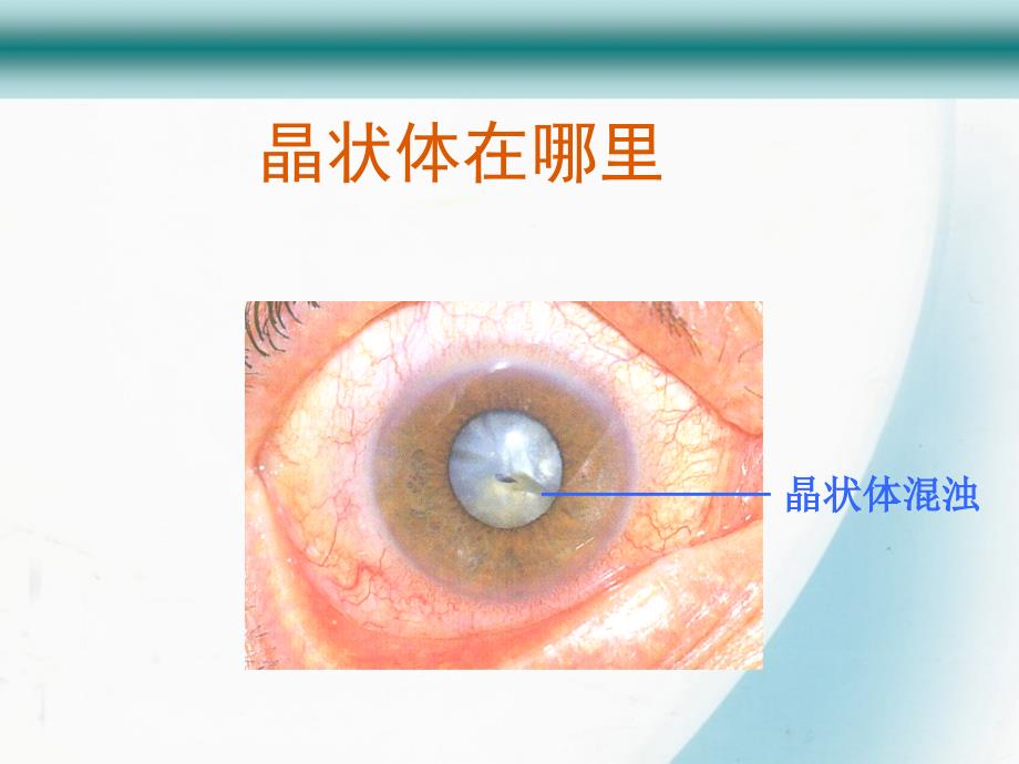 白内障相关知识健康宣教_第3页