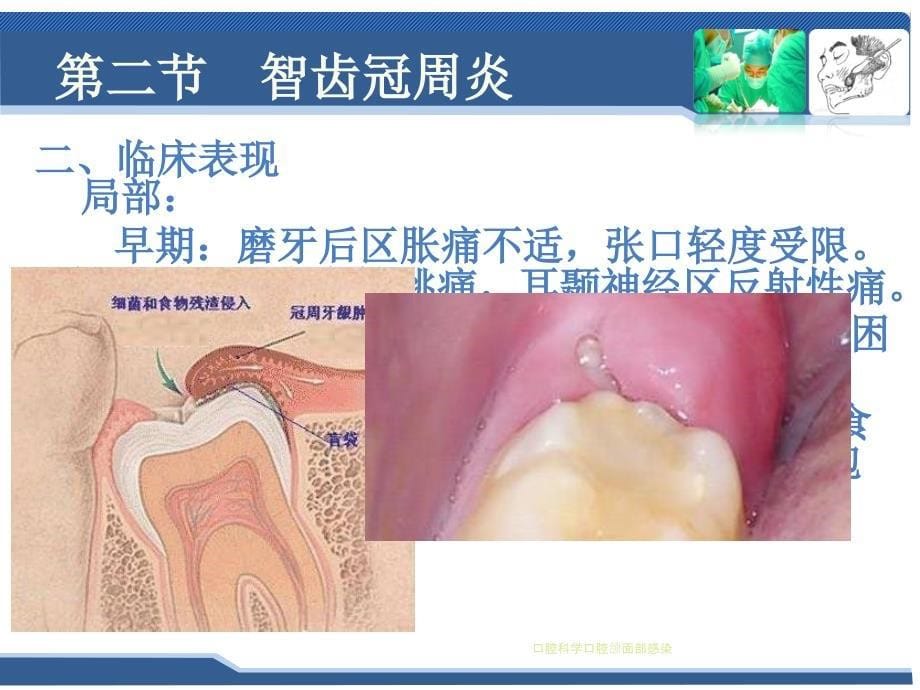 口腔科学口腔颌面部感染课件_第5页