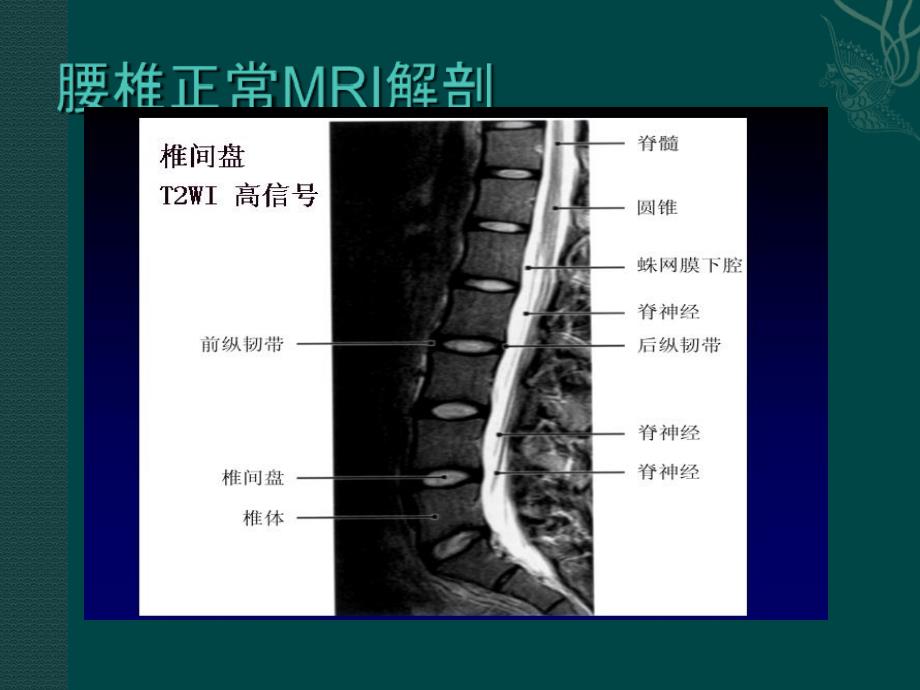 腰椎间盘的MRI诊断_第2页