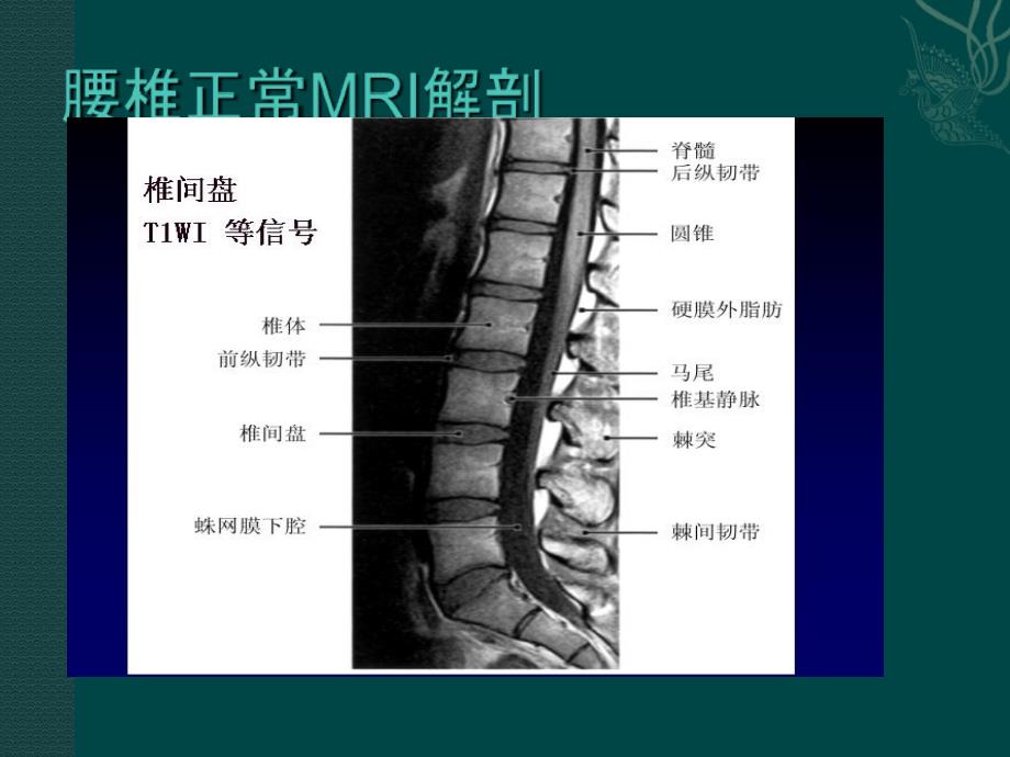 腰椎间盘的MRI诊断_第3页