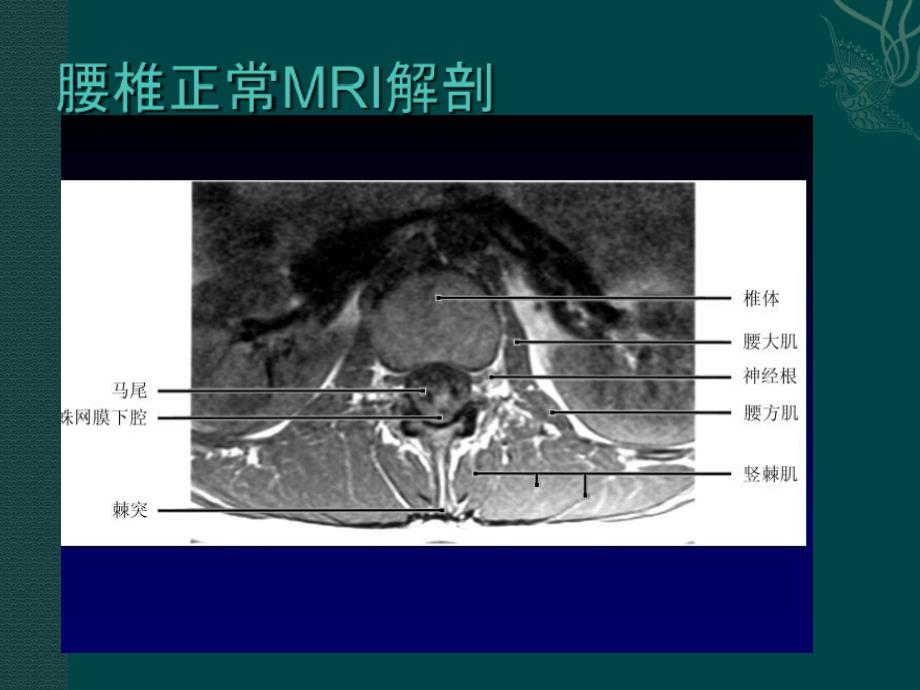 腰椎间盘的MRI诊断_第4页