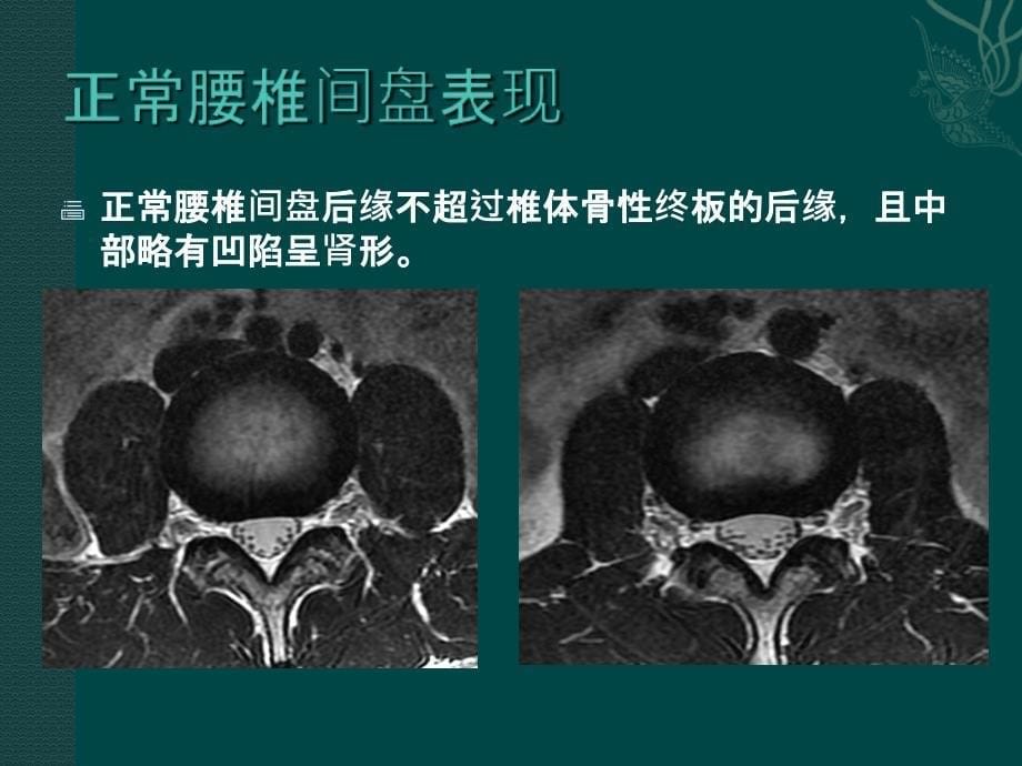 腰椎间盘的MRI诊断_第5页