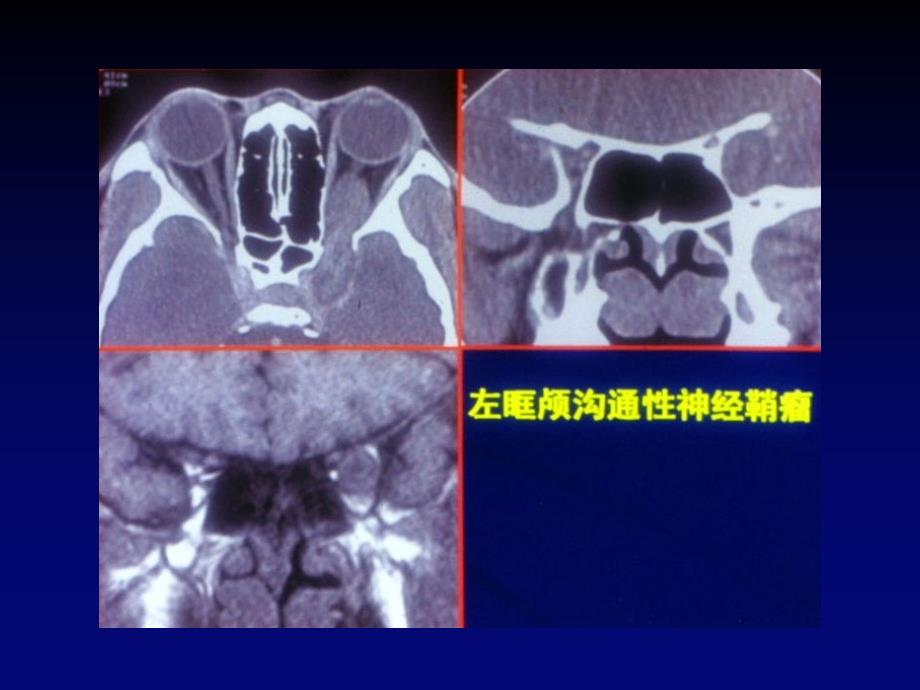 眼眶肿瘤的CTMRI诊断_第4页