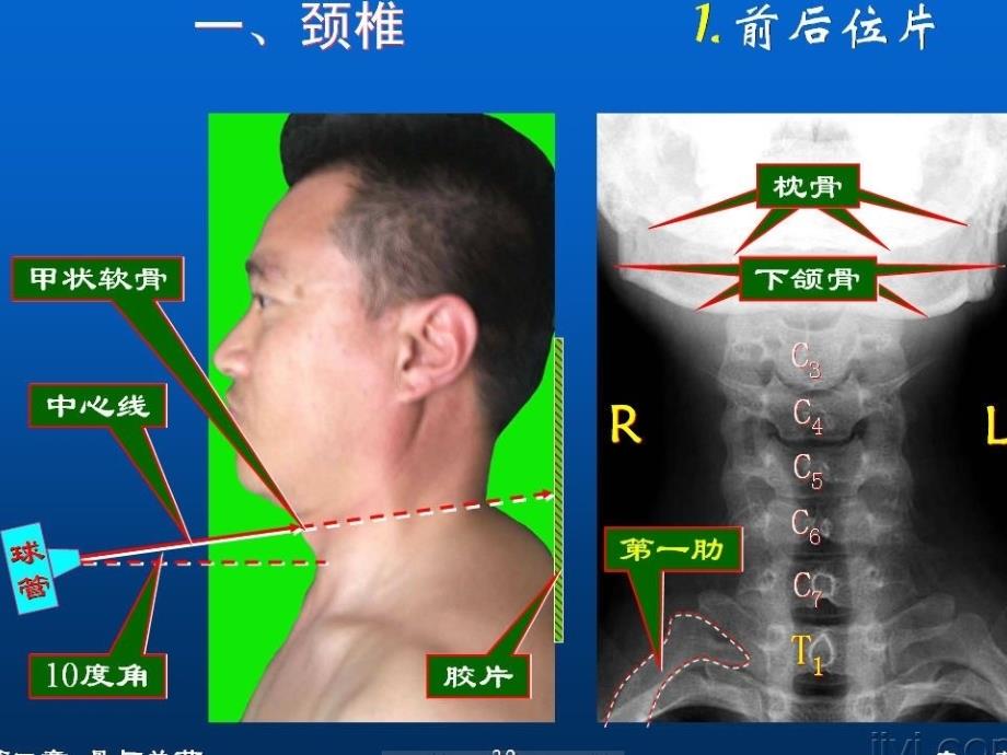 颈椎影像解剖学医学PPT课件_第3页