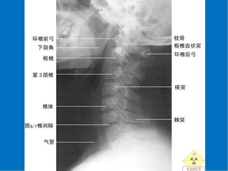 颈椎影像解剖学医学PPT课件_第5页