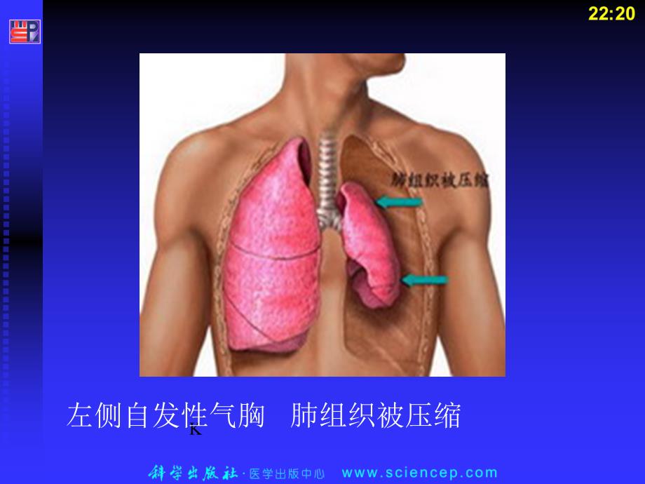 呼吸系统12 自发性气胸_第2页