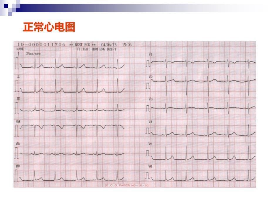 临床危急心电图的识别_第5页