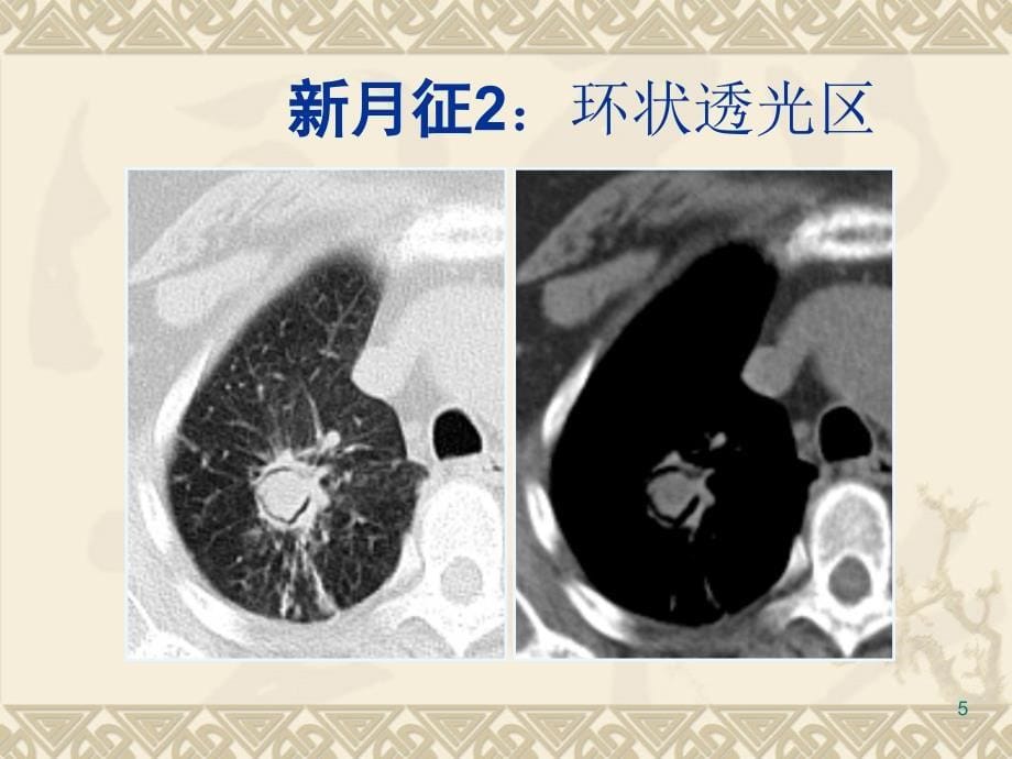 柳澄 肺曲霉菌感染的CT表现及鉴别诊断_第5页