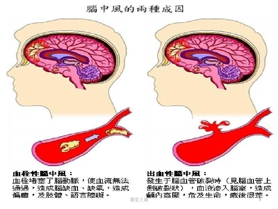 脑卒中的康复护理（行业经验）_第5页