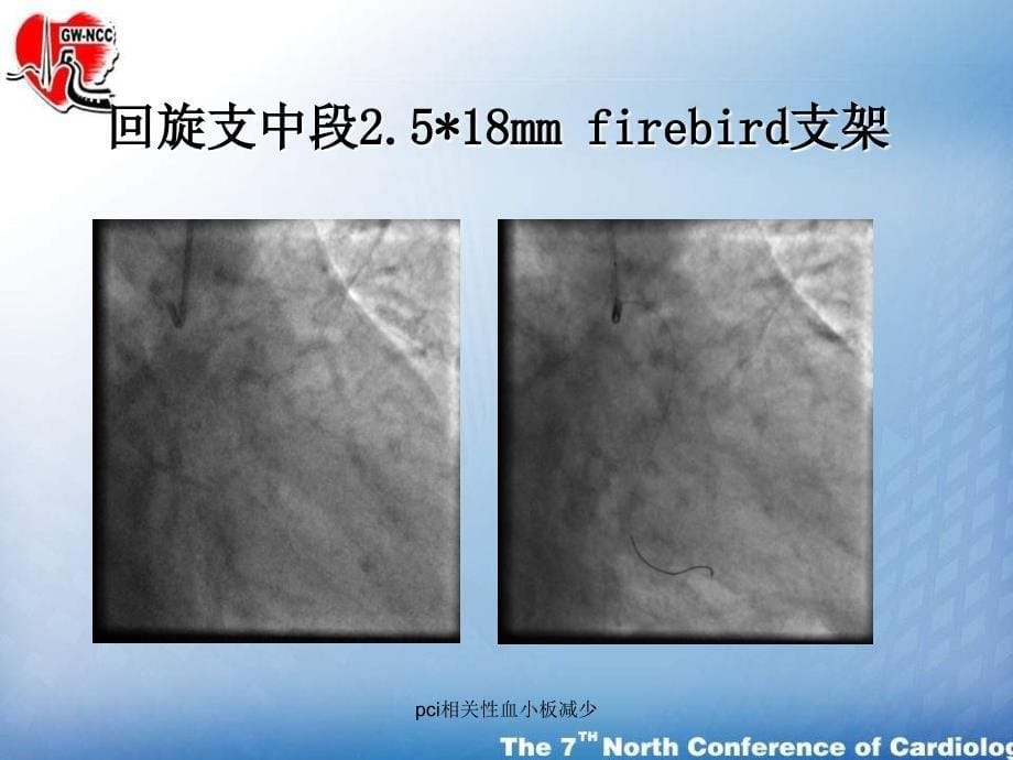 pci相关性血小板减少课件_第5页