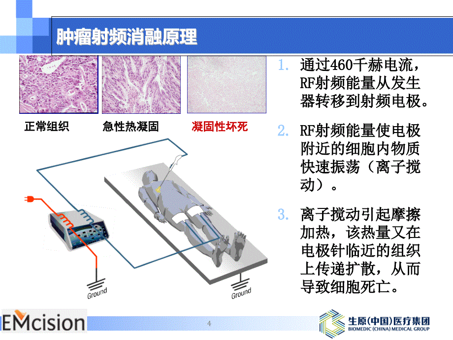 胆道射频消融技术.ppt_第4页