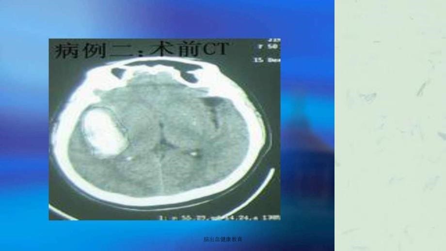 脑出血健康教育课件_第5页