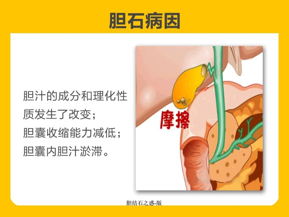 胆结石之惑版课件_第3页