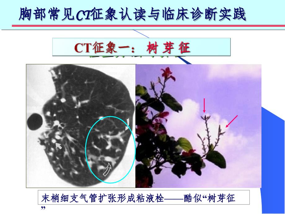 肺部CT十大征象(课堂PPT)_第4页