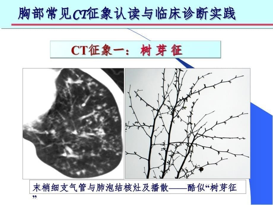 肺部CT十大征象(课堂PPT)_第5页