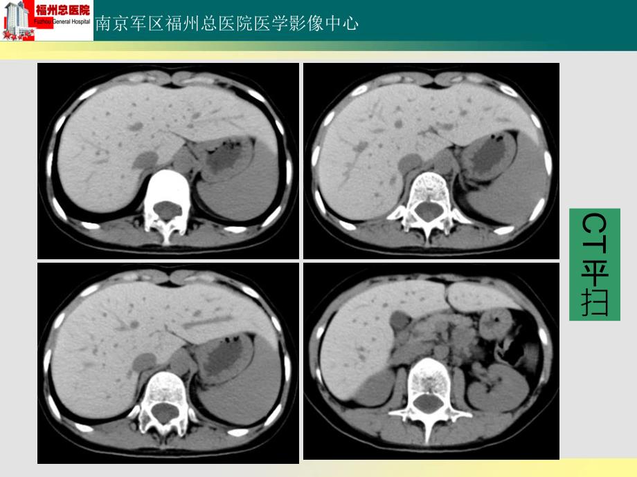 肝血色病读片_第3页