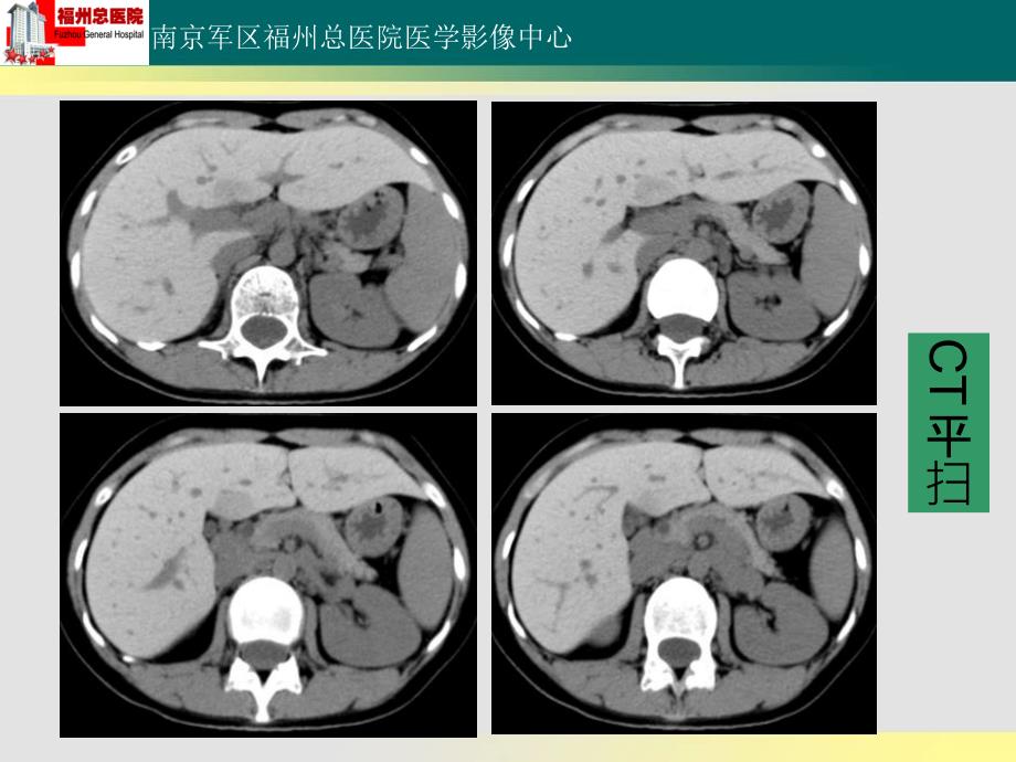 肝血色病读片_第4页