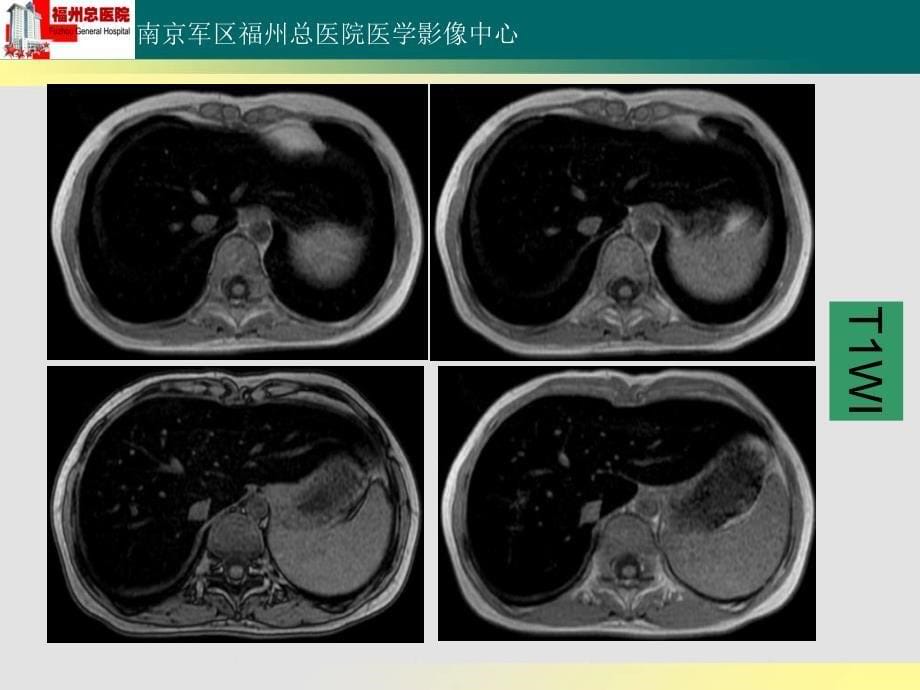 肝血色病读片_第5页