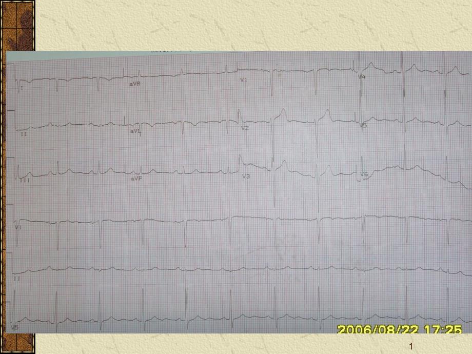 心电图正常值PPT课件_第1页