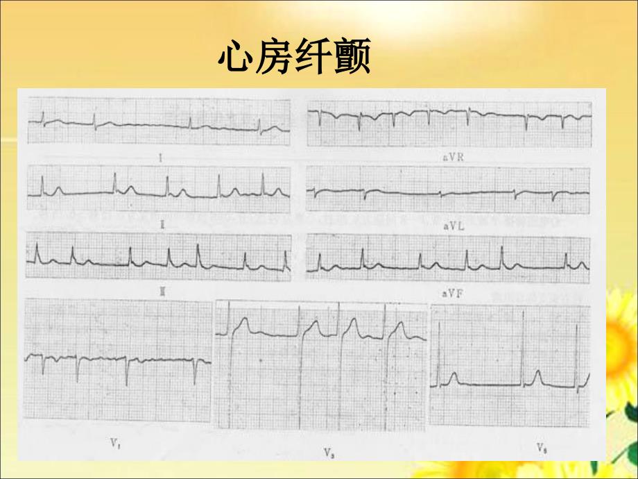 最新心房纤颤的治疗12315PPT课件_第2页