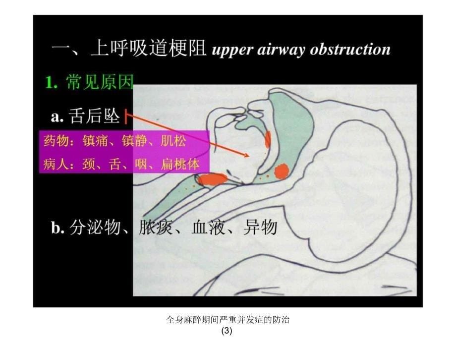 全身麻醉期间严重并发症的防治3课件_第5页