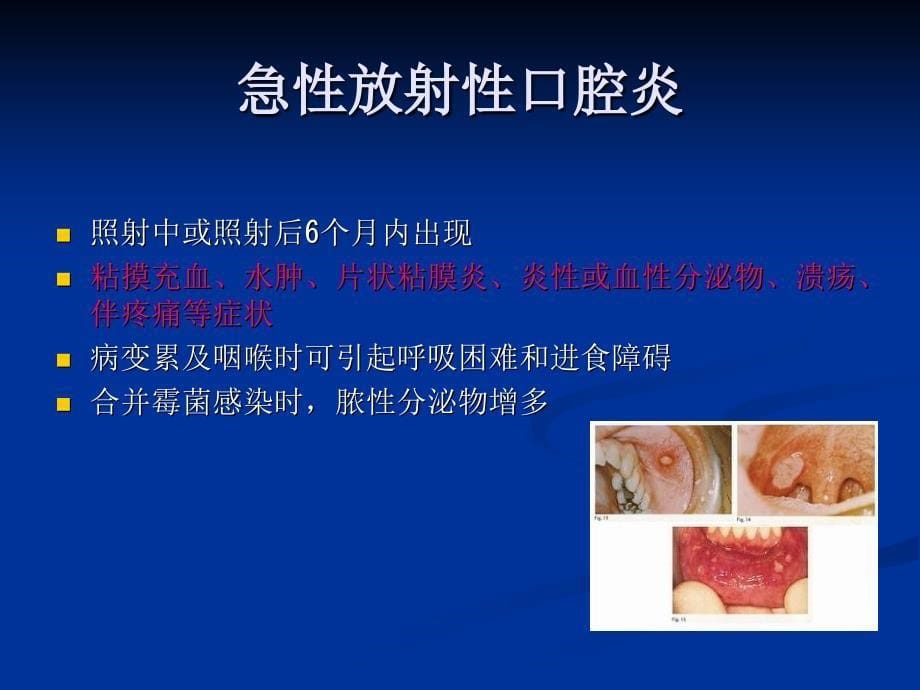 放疗并发症PPT课件_第5页