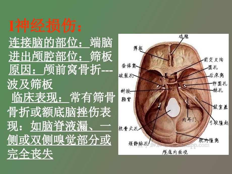 颅脑损伤合并颅神经损伤的临床表现_第3页