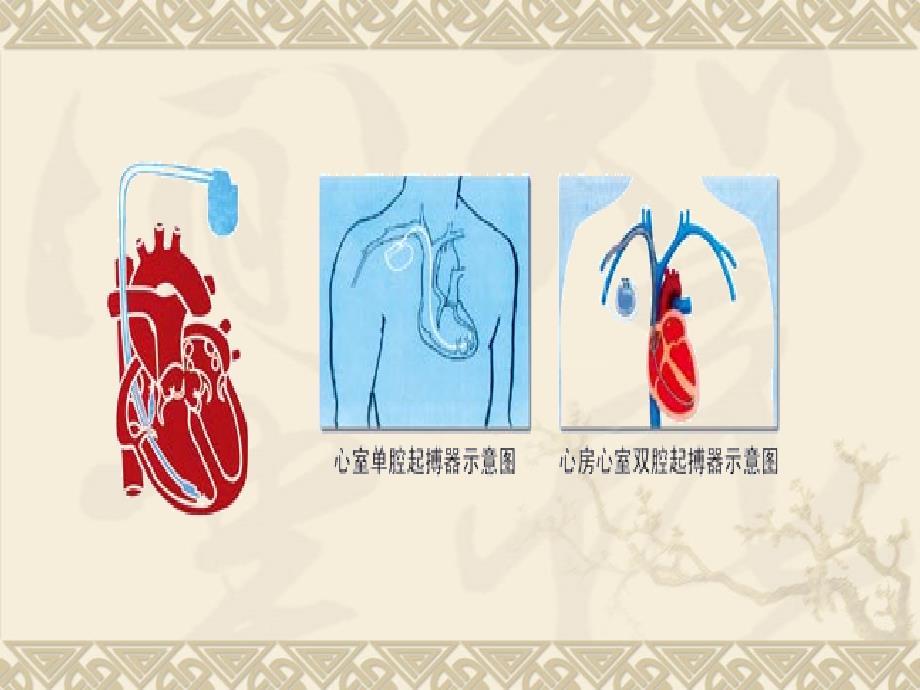 起搏器的护理_第4页