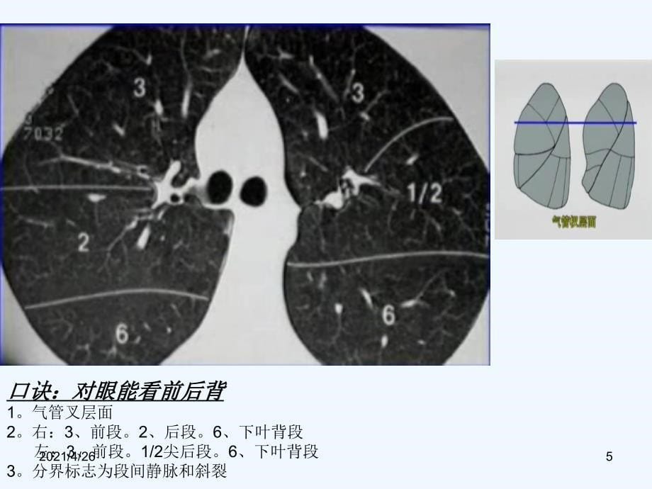 肺段CT识别口诀配图_第5页