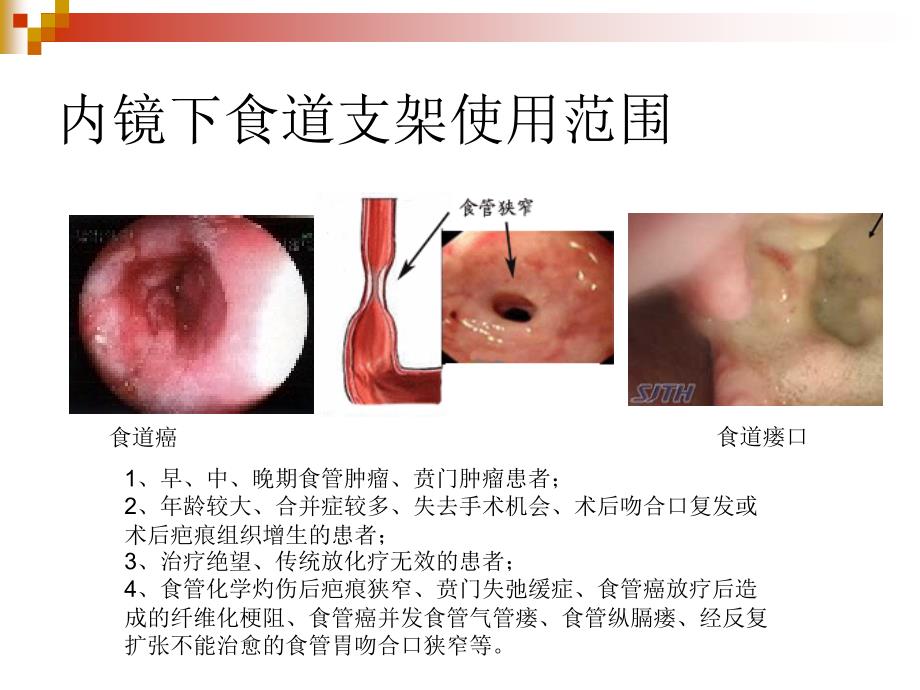 食道支架教学课件_第2页