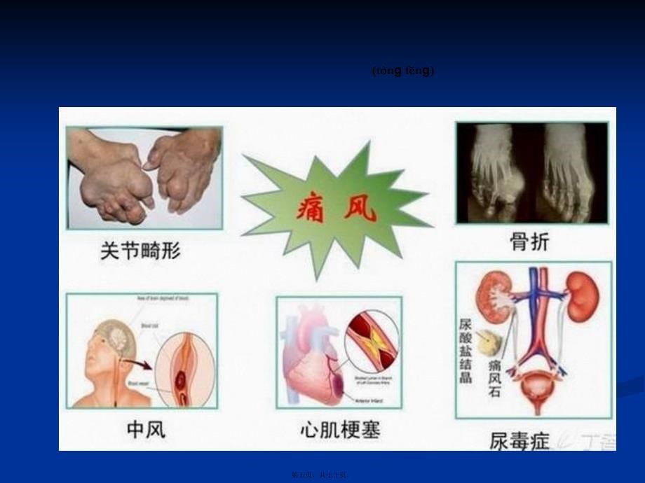 医学专题—痛风健康科普讲座26135_第5页