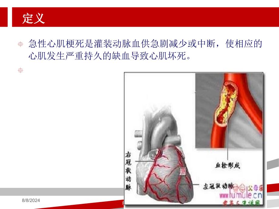 急性心肌梗死病人的护理.ppt课件_第3页