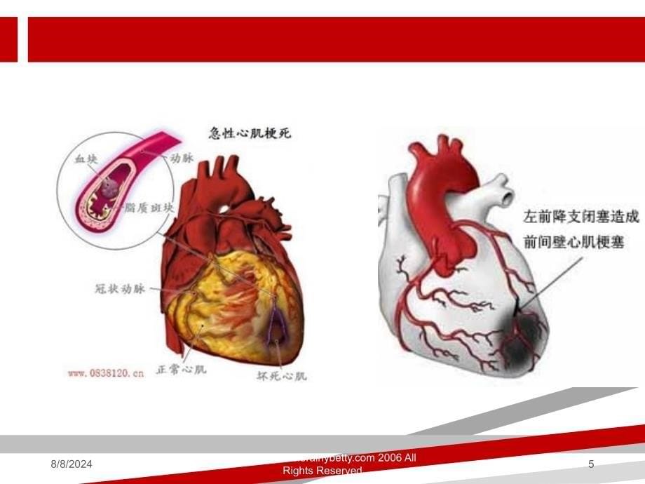 急性心肌梗死病人的护理.ppt课件_第5页