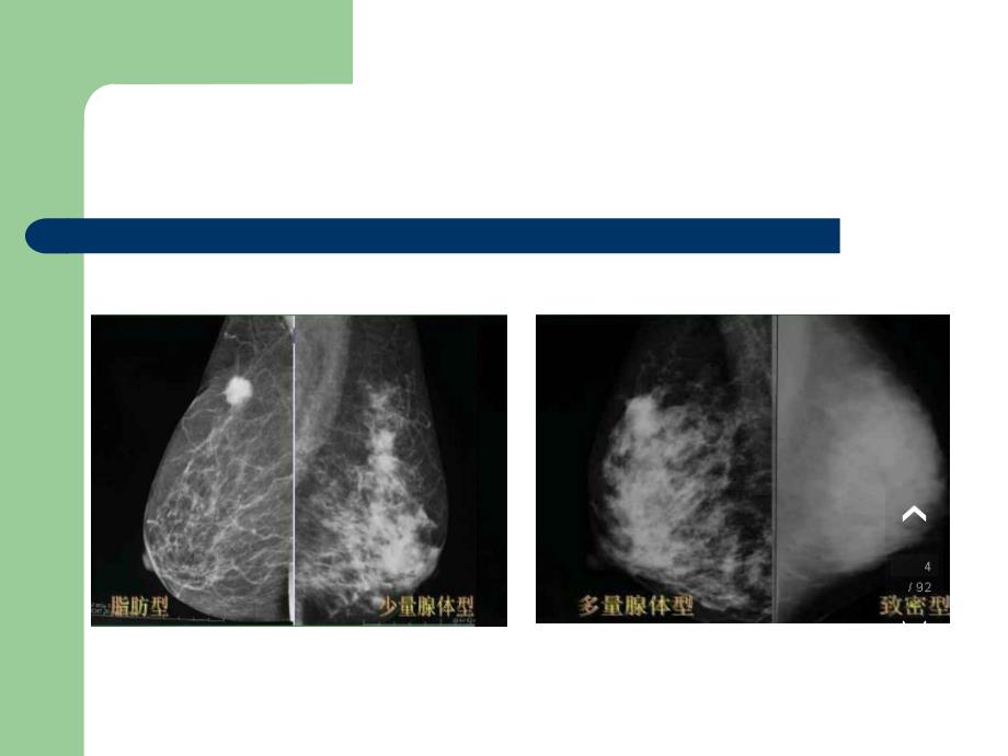 乳腺BI-RADS分级剖析_第4页