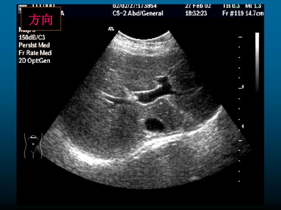 肝脏超声教授讲坛PPT课件_第4页