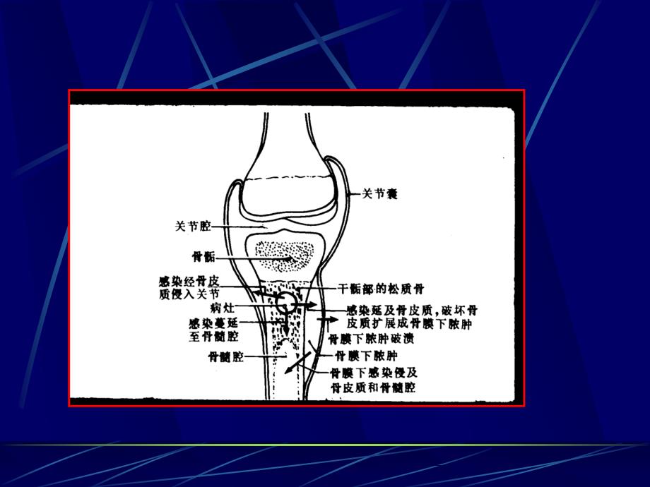 化脓性骨髓炎的影像学诊断_第4页