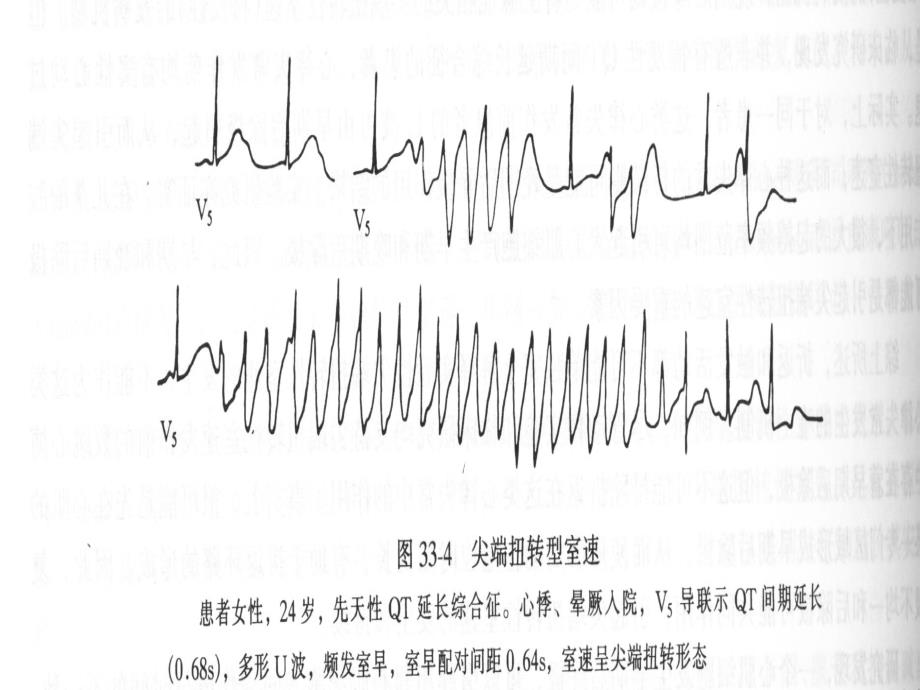 QT间期延长综合征_第3页