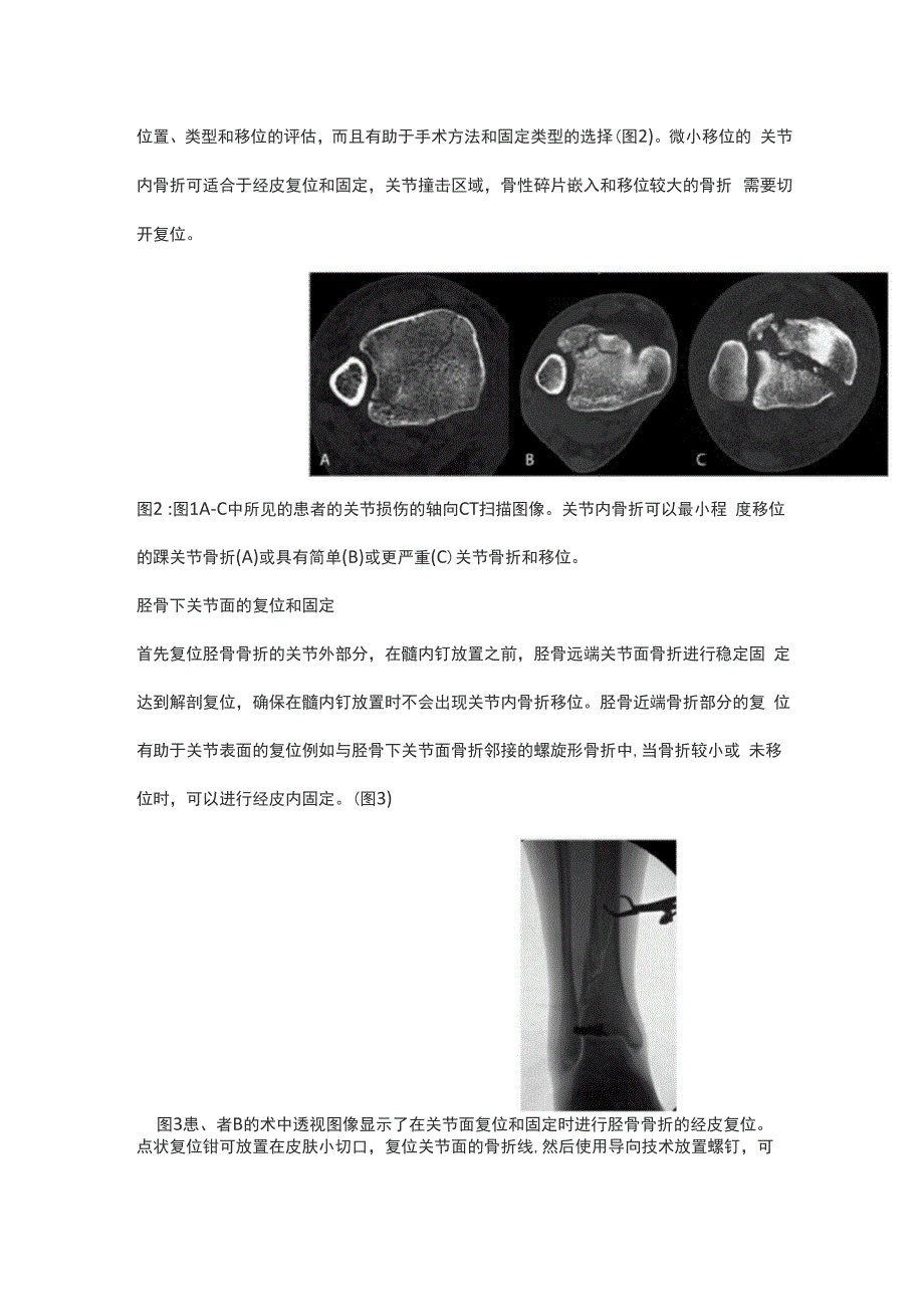 胫骨远端简单关节内骨折的髓内钉固定_第4页