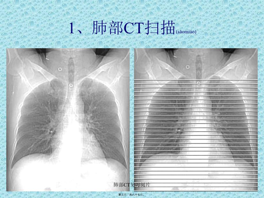 肺部CT见习阅片课件_第3页