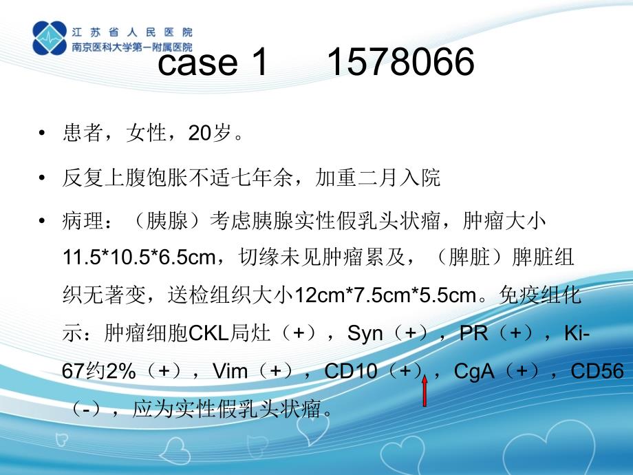 胰腺实性假乳头状瘤_第2页