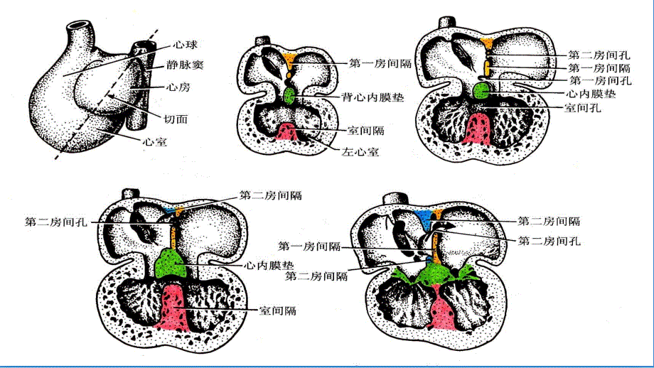 房间隔缺损PPT[优质严选]_第4页