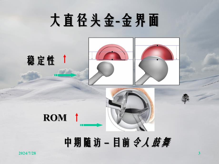 改良后外侧小切口金金大直径头全髋置换治疗高龄股骨颈_第3页